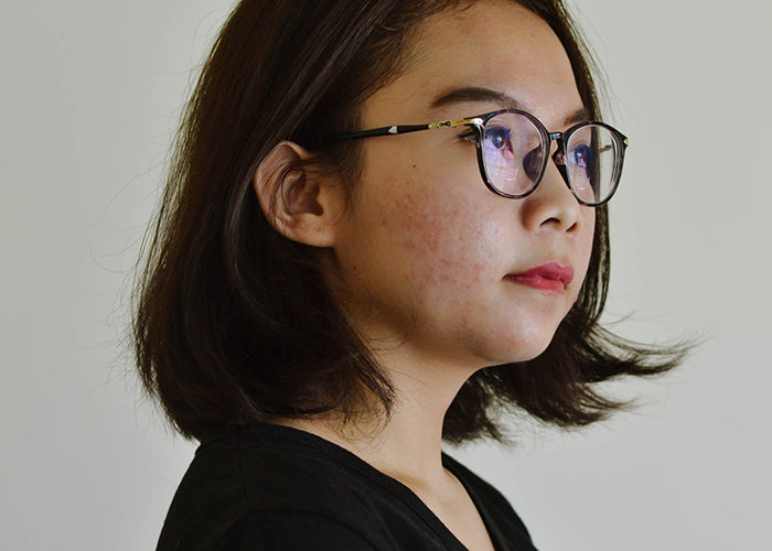 Five Common Skin Conditions That Aren't Acne