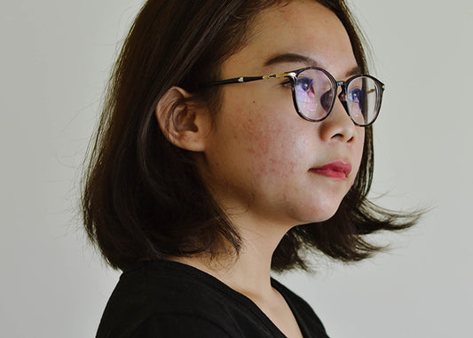 Five Common Skin Conditions That Aren't Acne