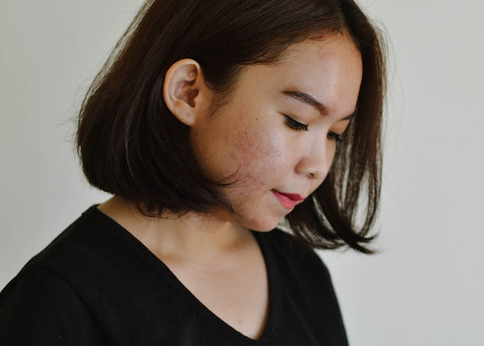 How to Fix Cystic Acne
