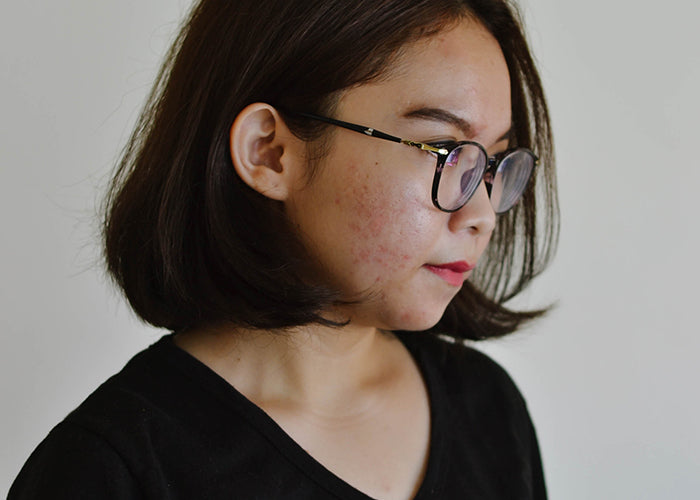 The Painful Reality of Adult Acne